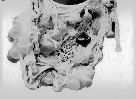 Pathological specimens of Hydatids cysts