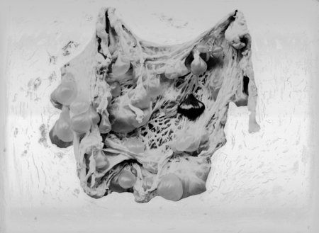 Pathological specimens of Hydatid cysts