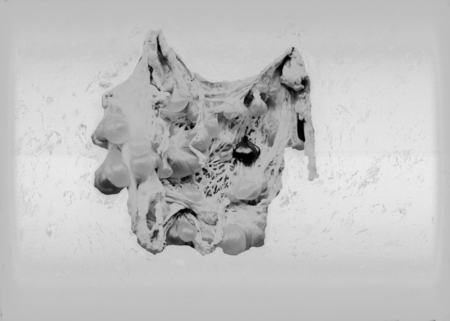 Pathological specimens of Hydatids cysts
